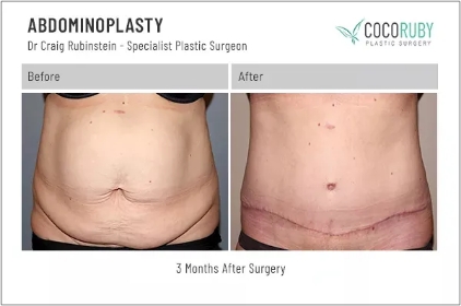 abdominoplasty1-ba-img
