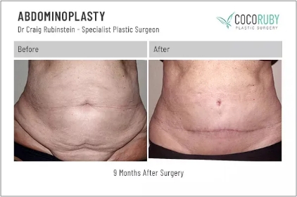 abdominoplasty2-ba-img