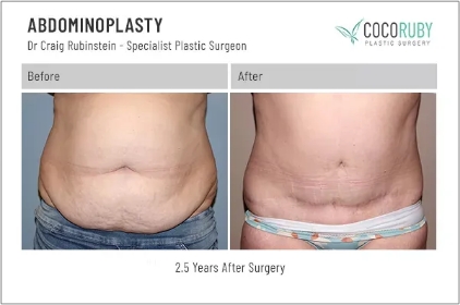 abdominoplasty3-ba-img