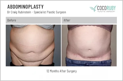 abdominoplasty4-ba-img