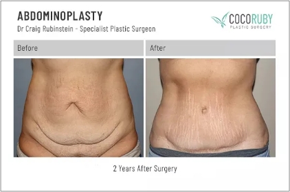abdominoplasty5-ba-img