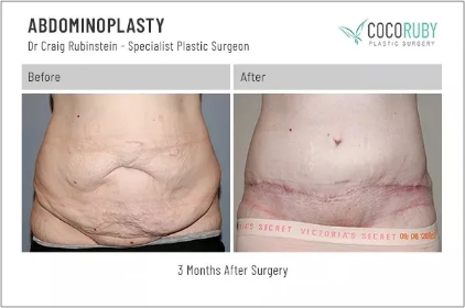 abdominoplasty6-ba-img